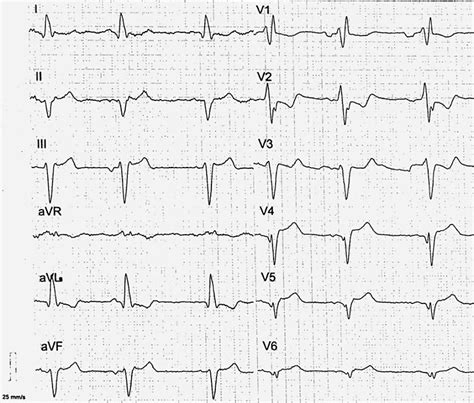 Standard 12 Lead Electrocardiogram Ecg Paper Speed 25 Mm Sec Download Scientific Diagram Standard 12 Lead Electrocardiogram Ecg Paper Speed 25 Mm Sec Download Scientific Diagram